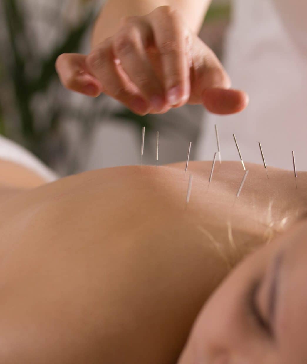 The doctor sticks needles into thegirl's body on the acupuncture, close-up